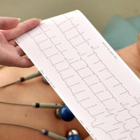 ECG